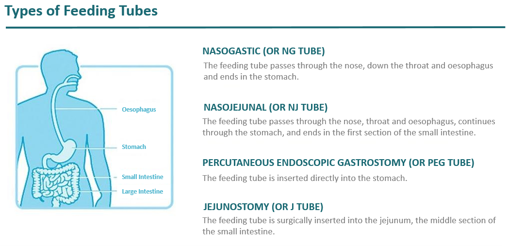 METHODS OF ENTERAL FEEDING